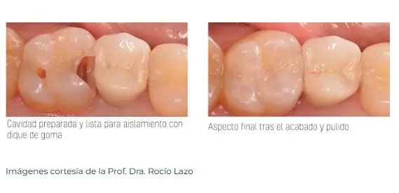 STELA SISTEMA AUTOPOLIMERIZABLE.webp